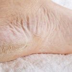 Kaki pecah